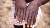 Mains d'un patient atteint de la variode du singe lors d'une épidémie en 1997 en RDC. (Archives - CDC via AP)