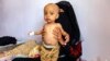 FILE - A woman holds a child suffering from malnutrition while sitting on a bed at a treatment center in al-Sabeen Maternal Hospital in the Houthi rebel-held Yemeni capital, Sanaa, June 22, 2019.